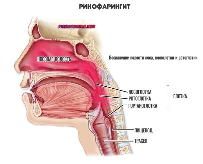 Осложнения острого назофарингита и ринофарингита