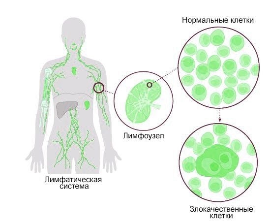 Определение стадии заболевания