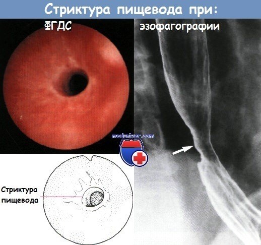 Патогенез