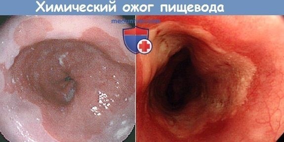 Какие симптомы сопровождают ожог пищевода?